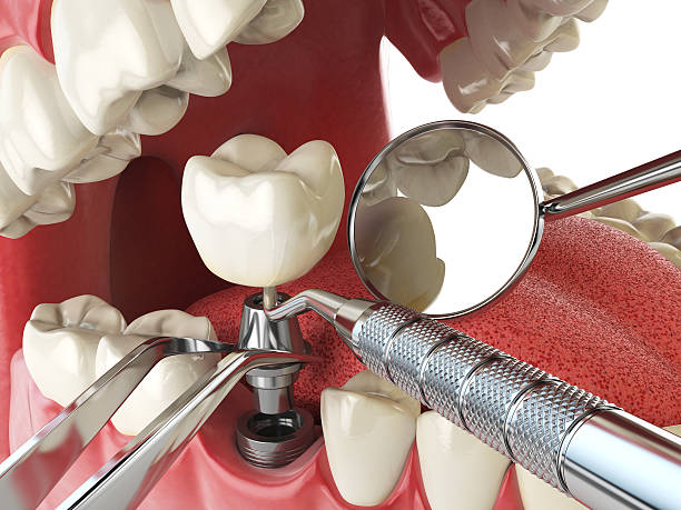 Best Emergency Dental Care for Sports Injuries in Steubenville, OH